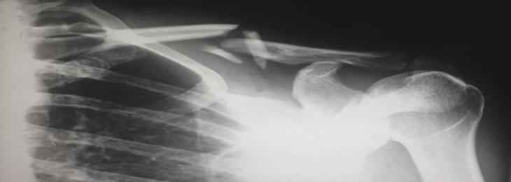 Novel Graphene-Infused Mesh May Help Repair Rotator Cuff Injuries