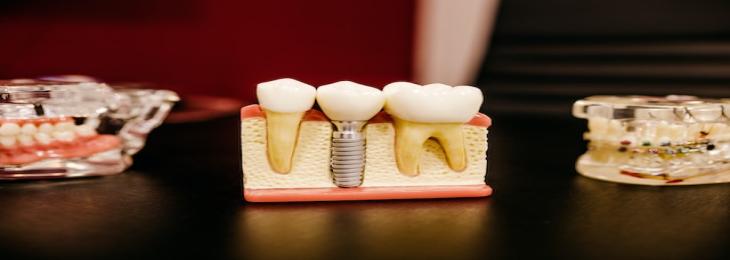 New Material Enhances and Restores Hardness of Original Tooth Enamel